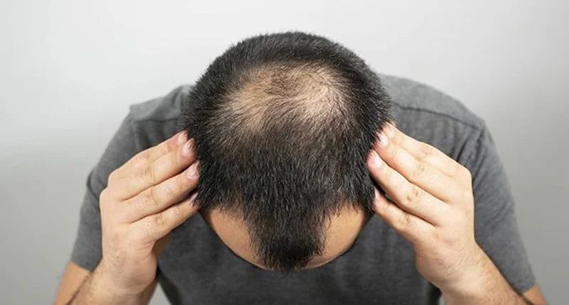 Best Hair Loss Treatment for Men: Why Plant Stem Cells Are the Future of Regrowth