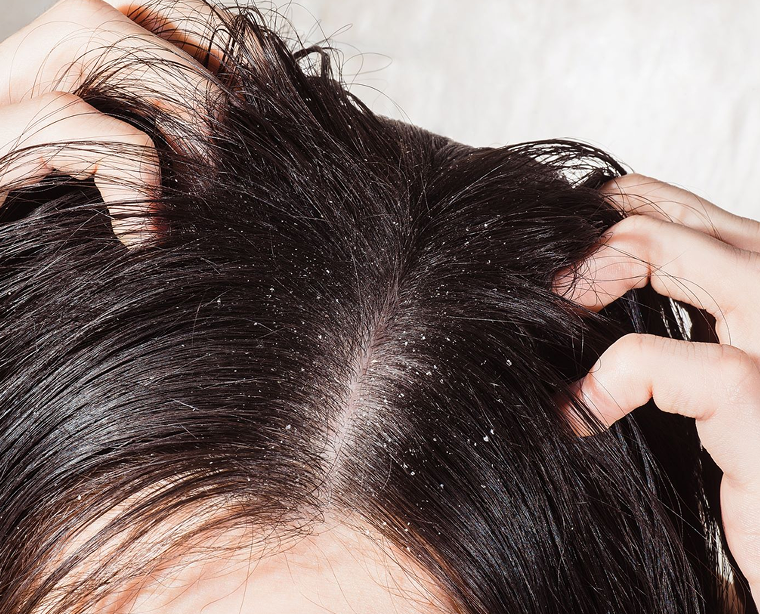 Dealing with Flaky Scalp: Causes and Solutions