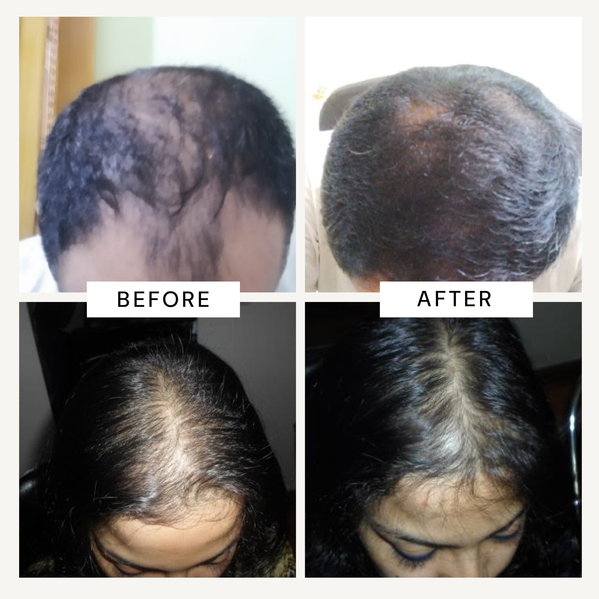 Richfeel Scalp Cleanser with Saw Palmetto | Anti-Hair Fall Shampoo
