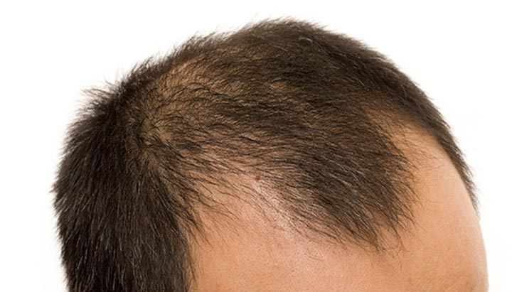 How to Choose the Best Hair Growth Serum for Thinning Hair