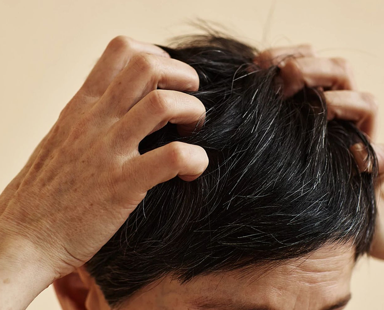 Get Rid of Itchy Scalp and Dandruff Fast