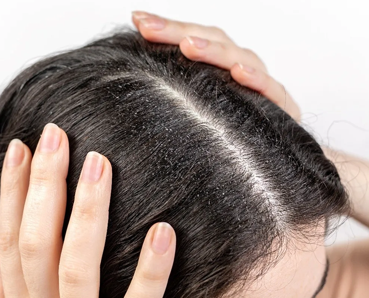 5 Effective Solutions for Hair Fall and Dandruff Problems