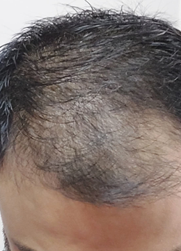 Month 0