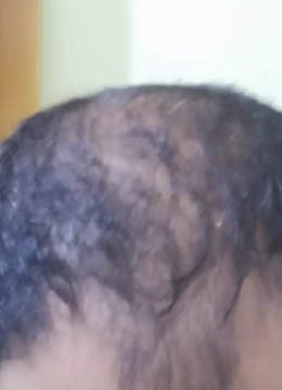 Month 0