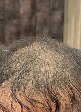 Month 0